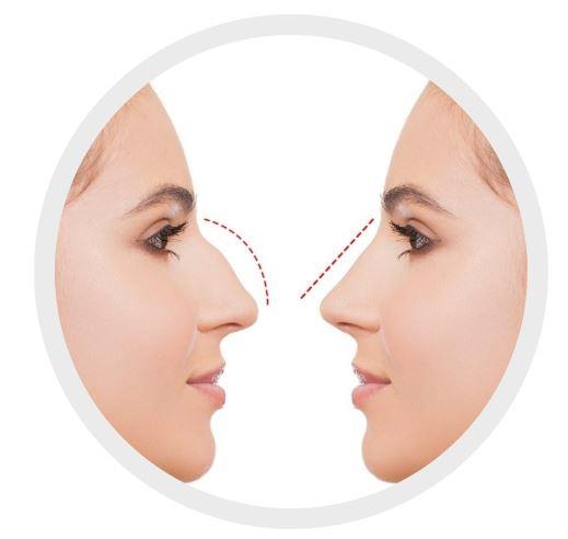 Ринопластика: Искусство и Наука Формирования Идеального Профиля